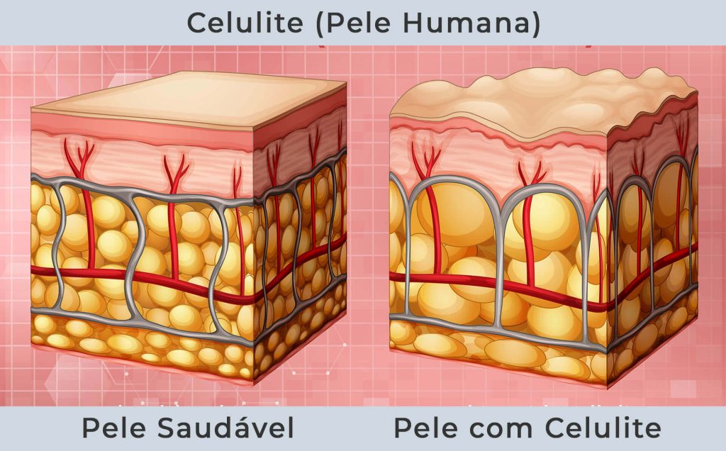 A Celulite é uma composição complexa que envolve gorduras e fibras