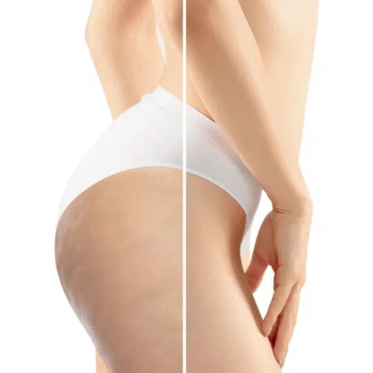 Collagen Vitta controla celulites